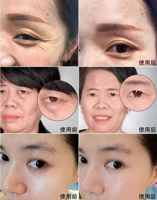 去眼袋的黑科技有哪些，去眼袋黑科技产品