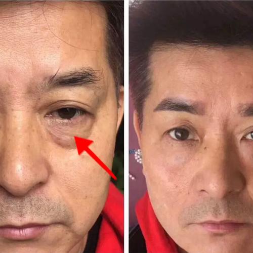 去眼袋的效果，去眼袋的产品真的有用吗