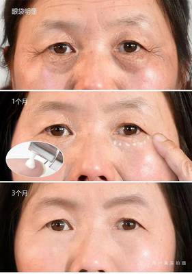 去眼袋神器还有哪些神器呢视频，去眼袋神器真的有用吗