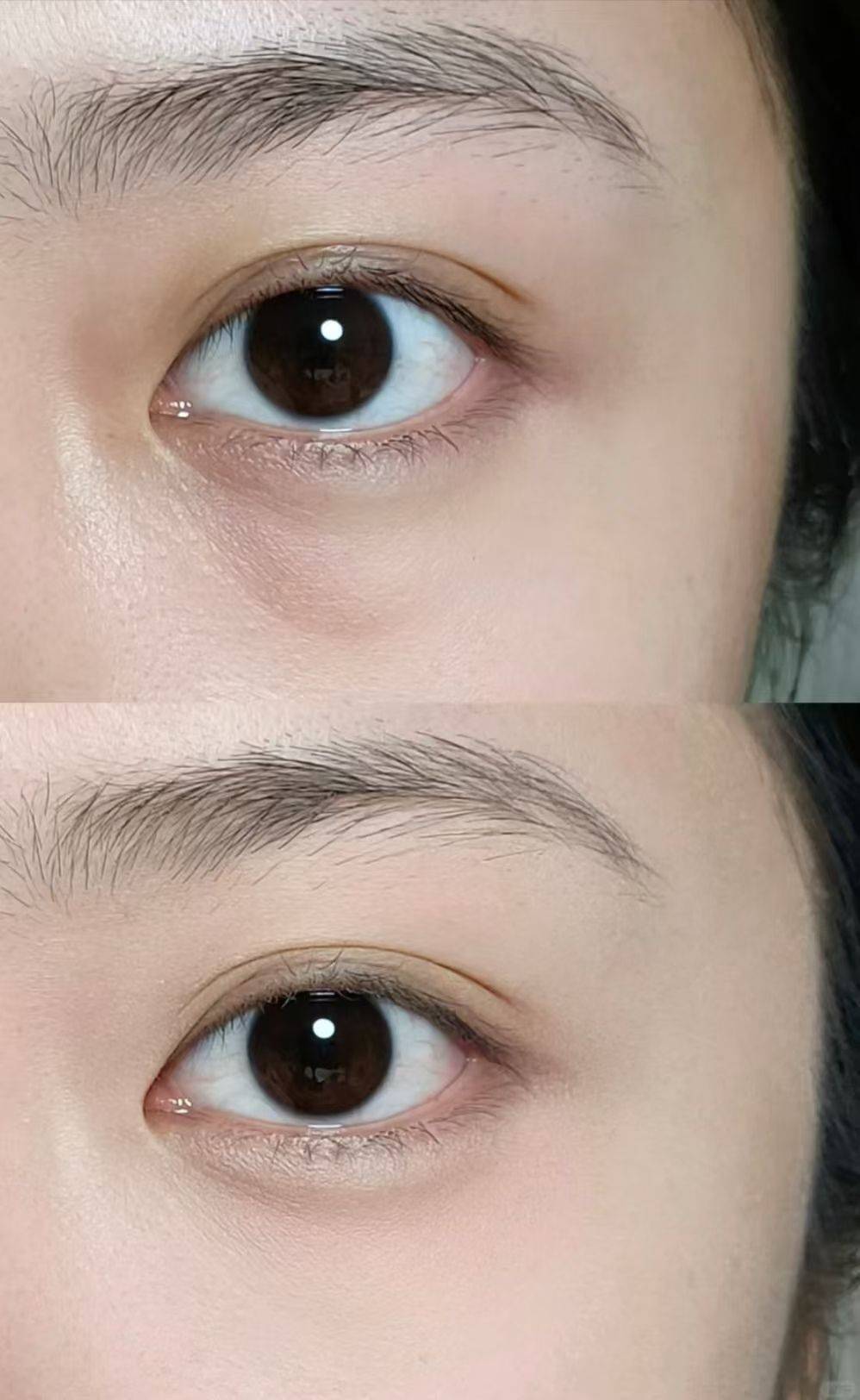 去眼袋排行榜10强，去眼袋最好的品牌