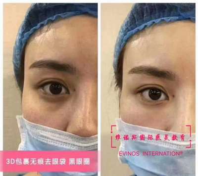 去眼袋新技术视频，去眼袋新技术有用吗
