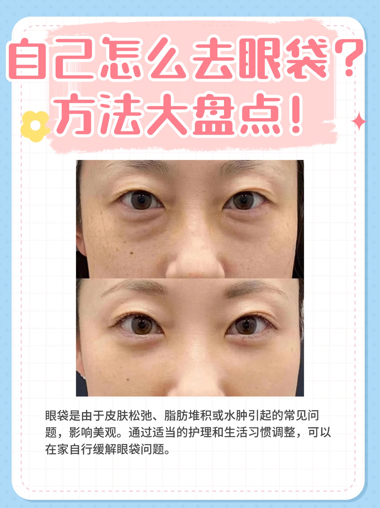 去眼袋的偏方秘方集合，祛眼袋的偏方